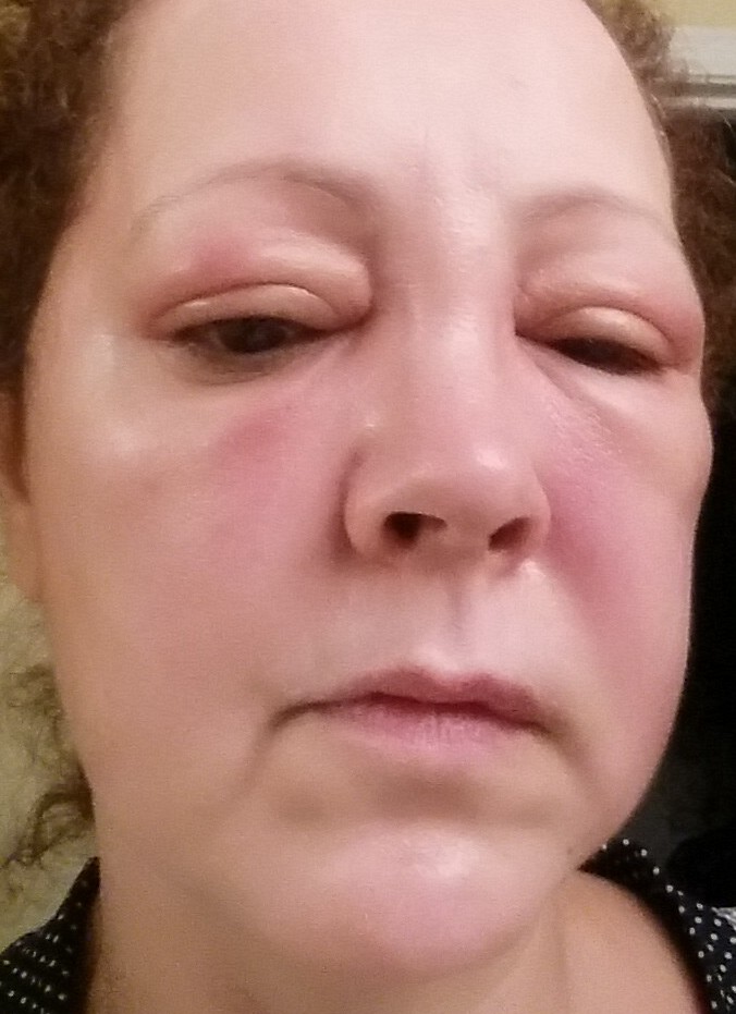 Five hours after I was stung by a wasp, my face was still swelling.